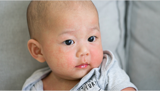 How to Handle Red and Itchy Skin in Children? Must-Know Skin Allergy Care Tips